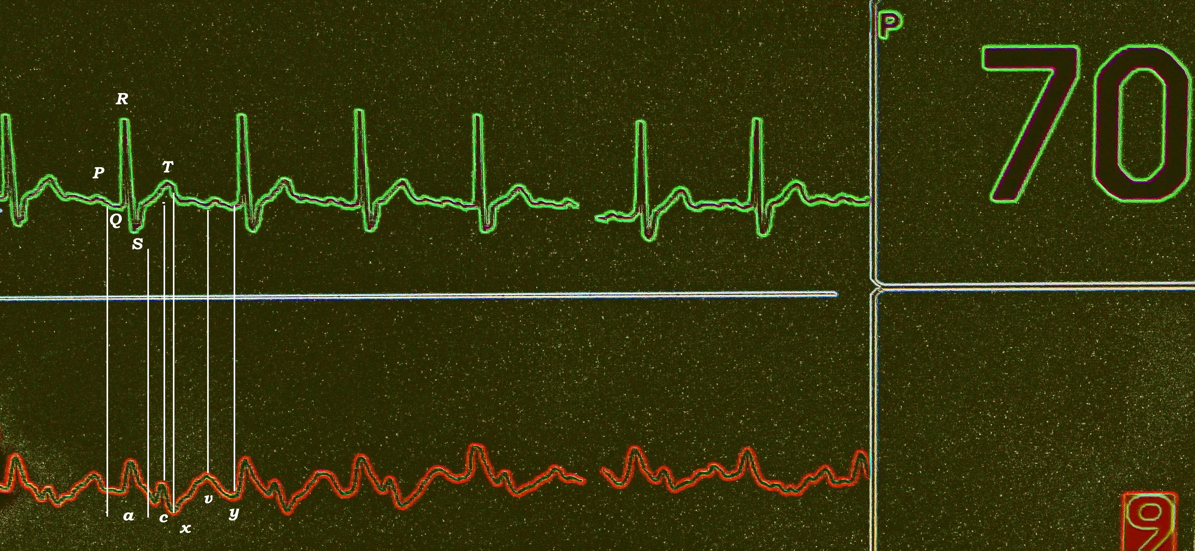 Georgia sued over fetal heartbeat abortion ban