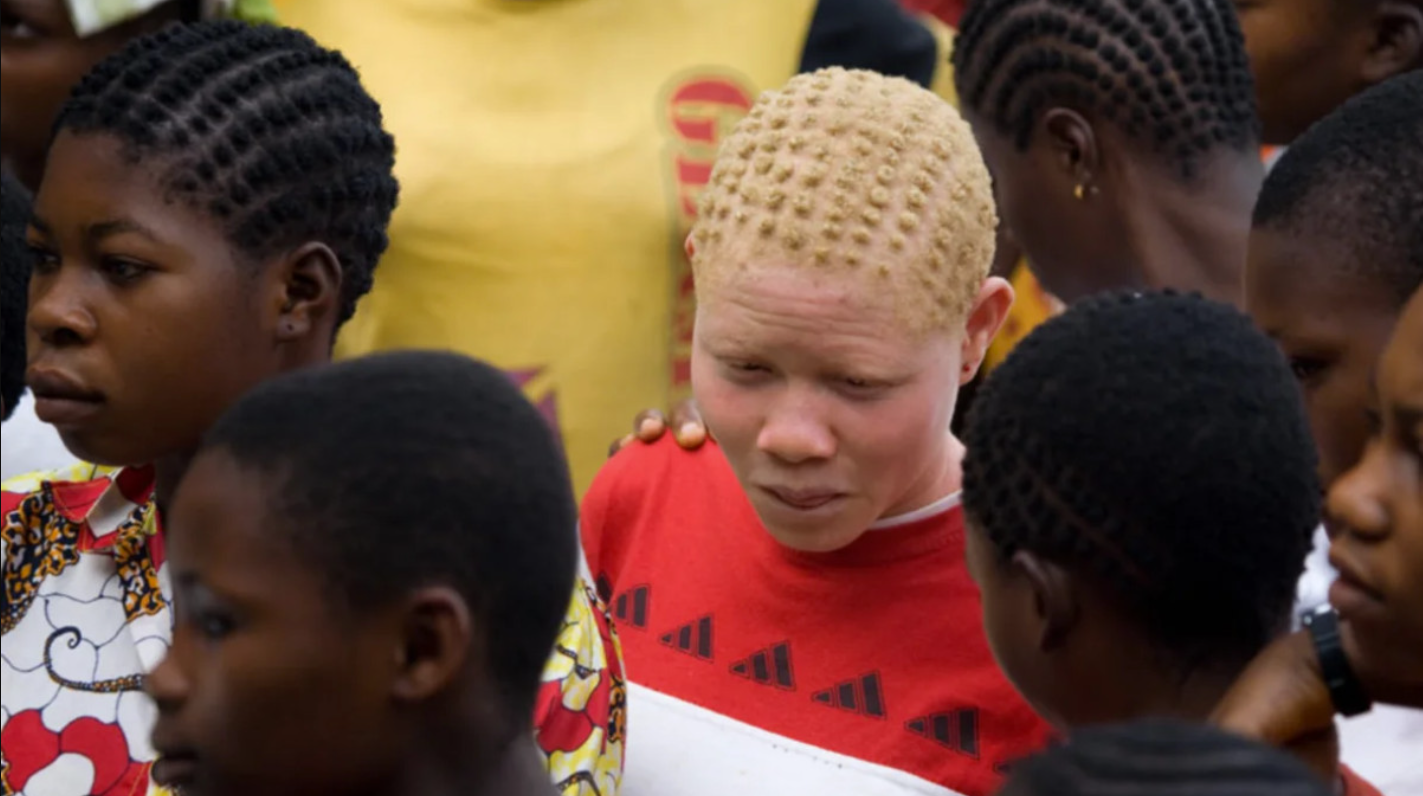 Stronger global protections needed for persons with albinism facing colour-based discrimination, UN expert says